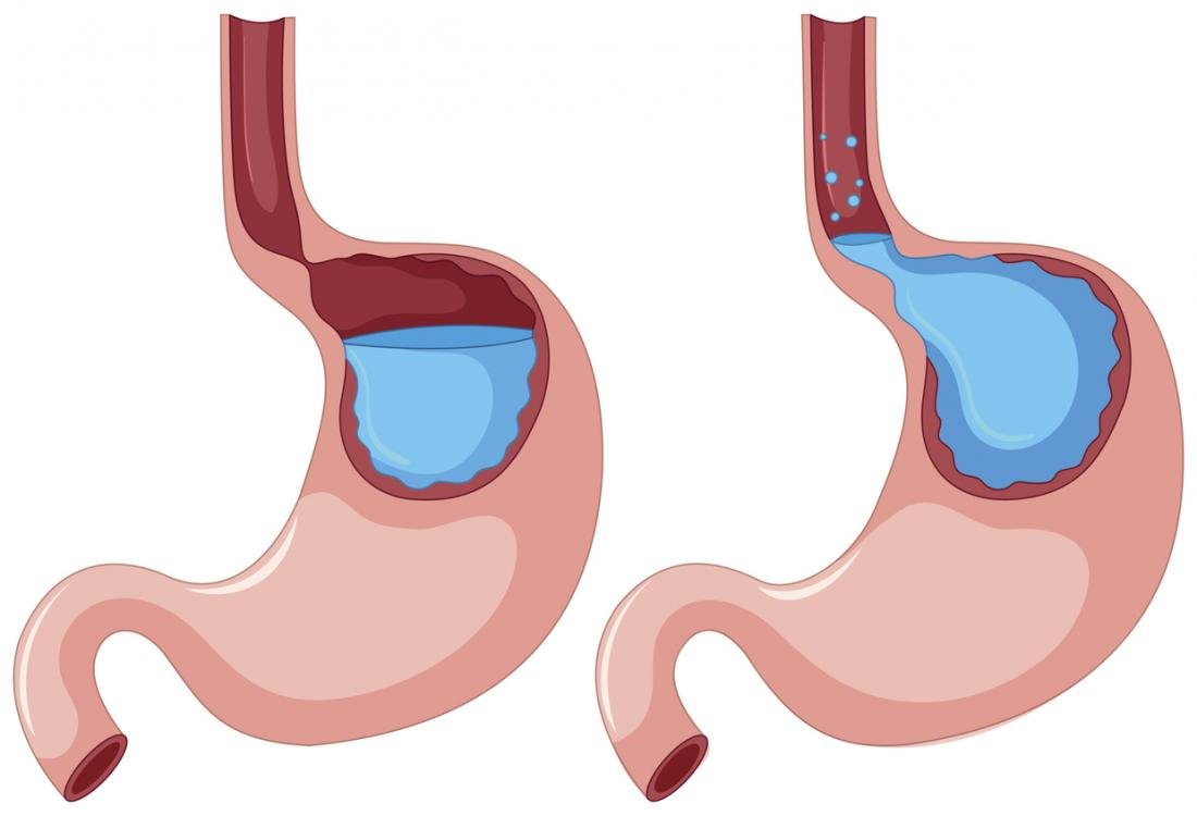 gastro – esophageal reflux disease